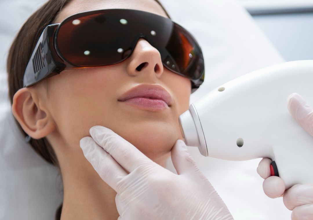 Upper Lip Laser
