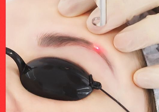 Eyebrows Laser Removal