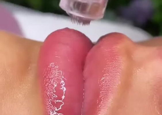 Hydra Lips