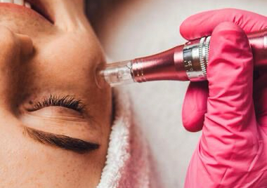 Microdremabrasion