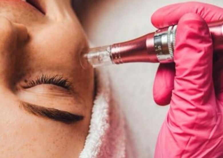 Microneedeling PDRN (salmon DNA)