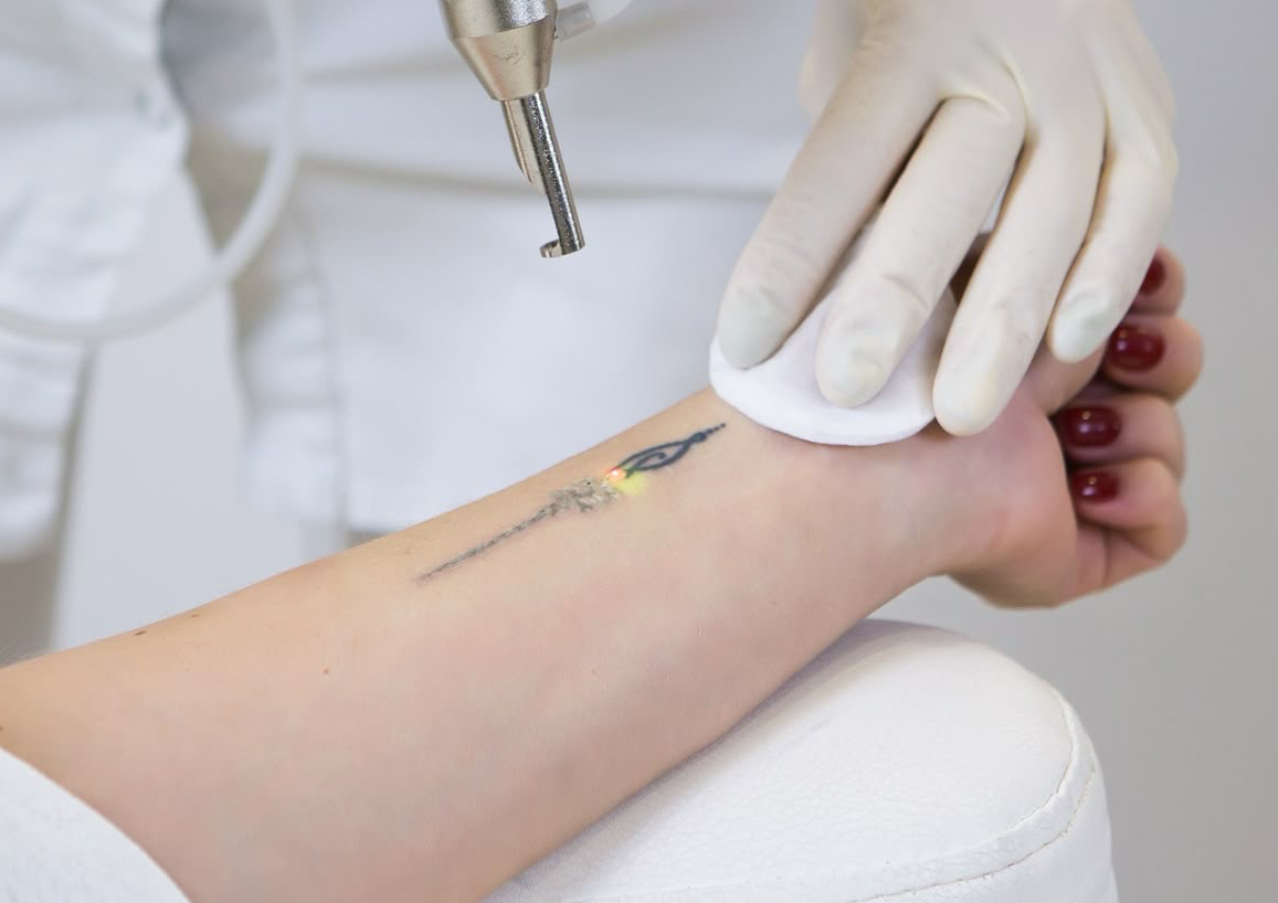 Tattoo Removal