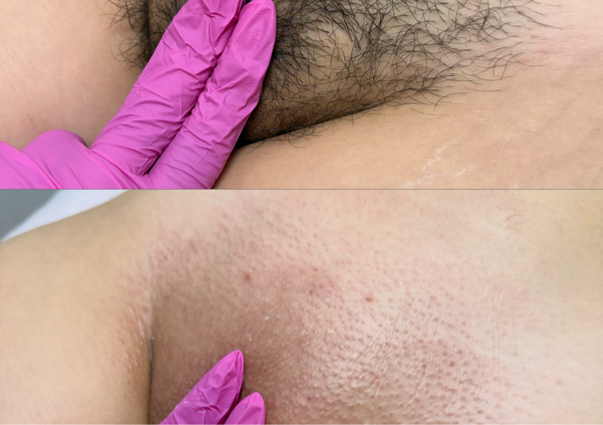 Brazilian Wax 1ra Cita