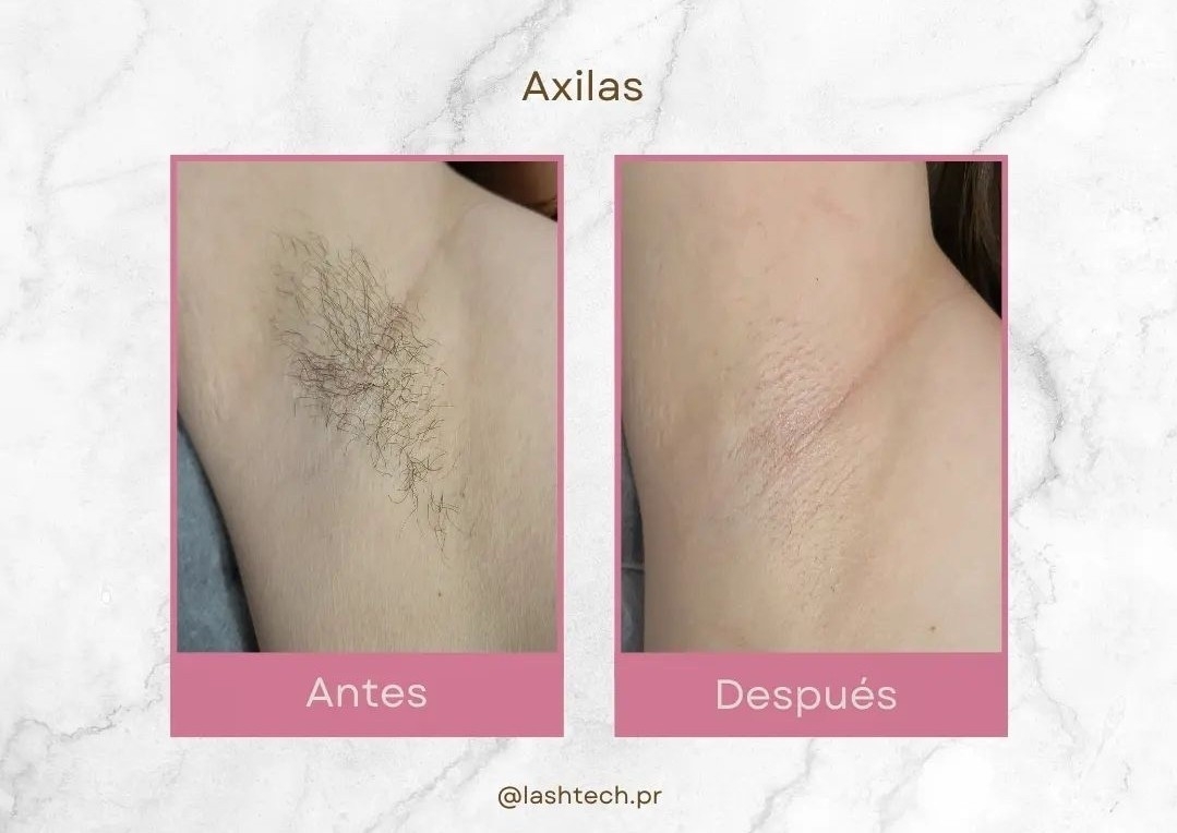Depilación de axilas 