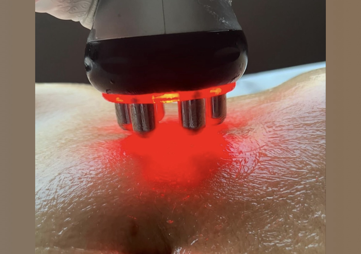 Radiofrecuencia 1 area 1 sesion 