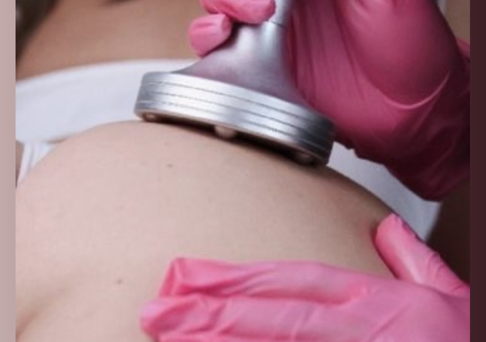 Vacuum terapia ( tonificante ) 1 area , 1 sesion