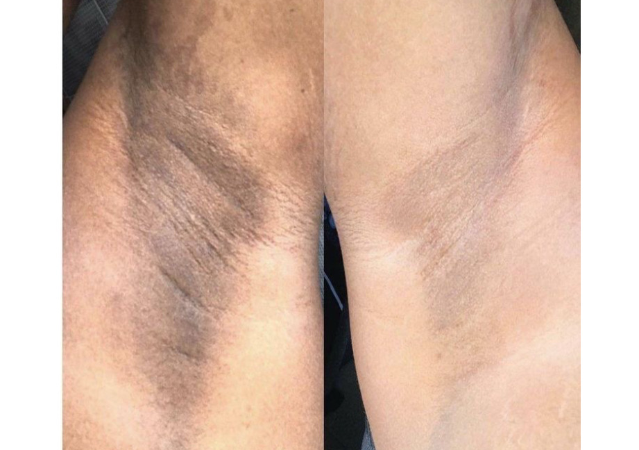 Underarm Intimate Brightening 