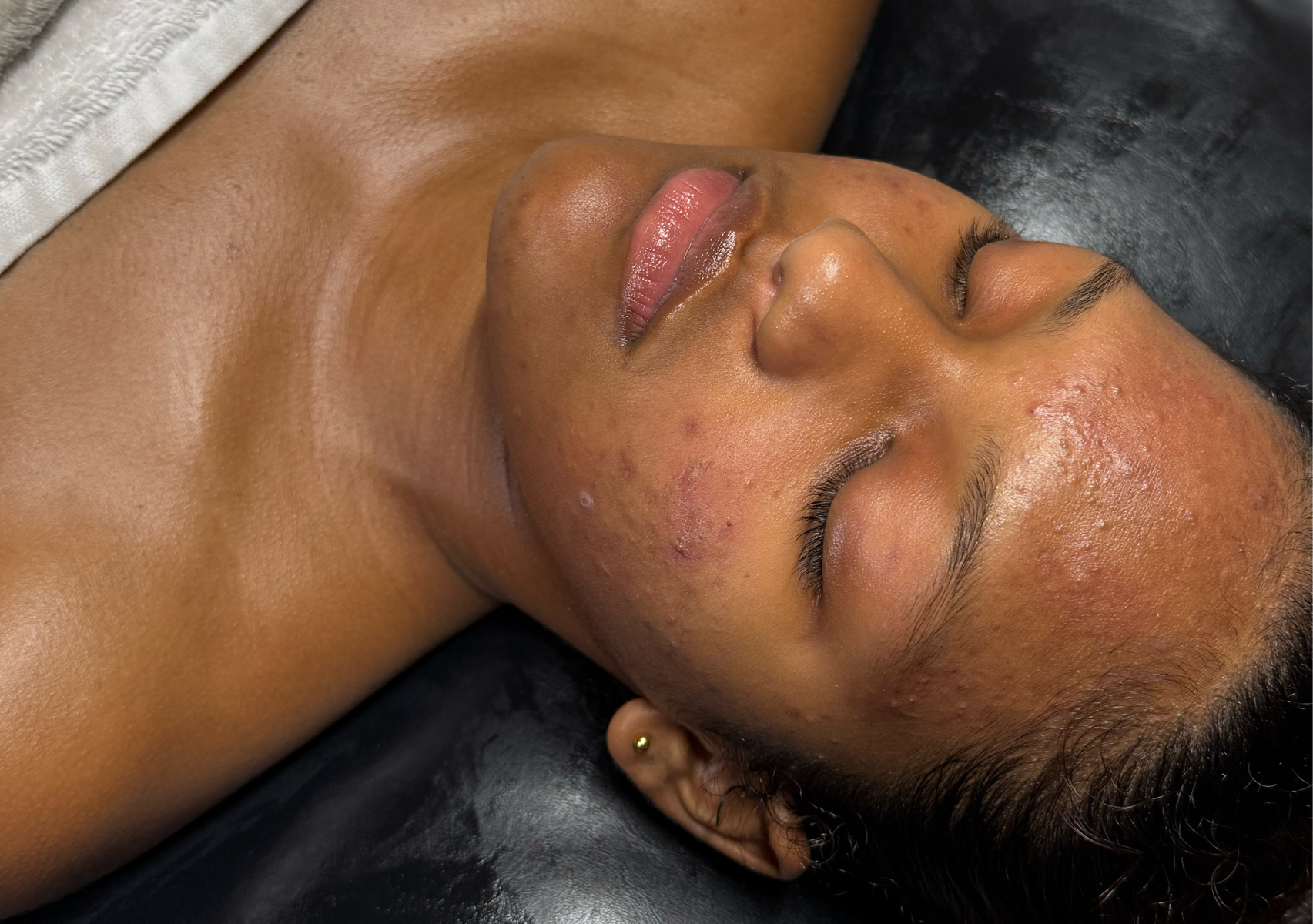 Be Bright Clinical Acne Essential Facial 