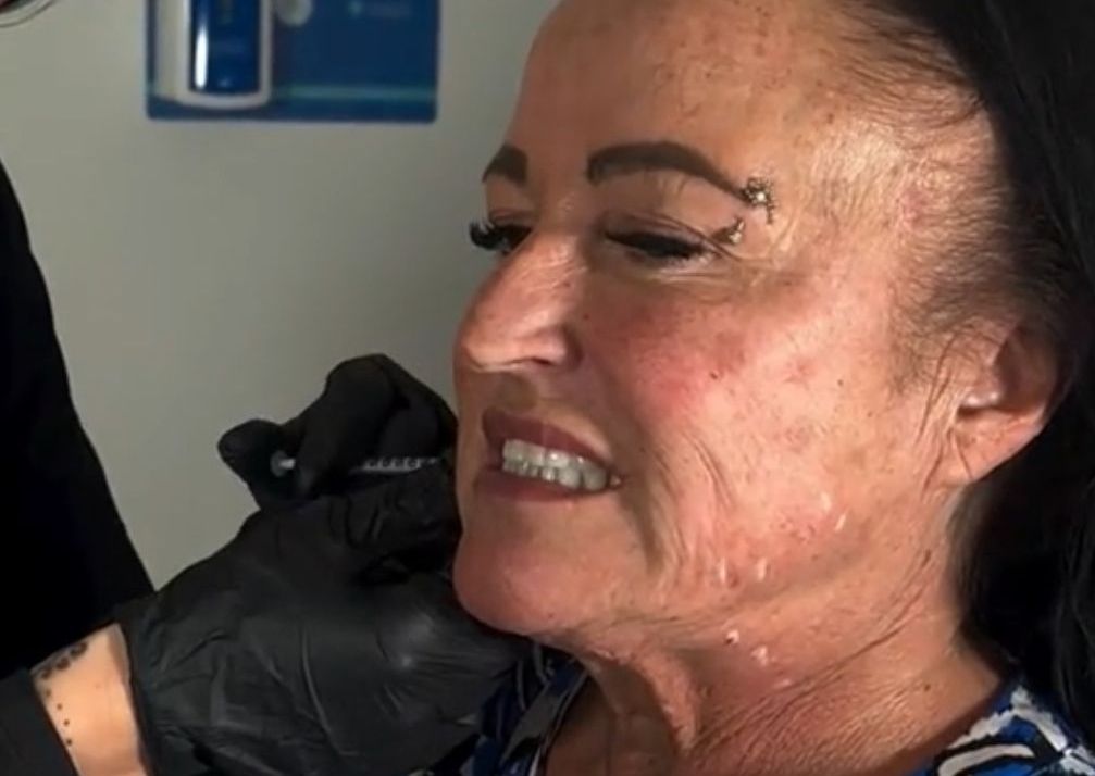 Masseter muscle (teeth grinding)