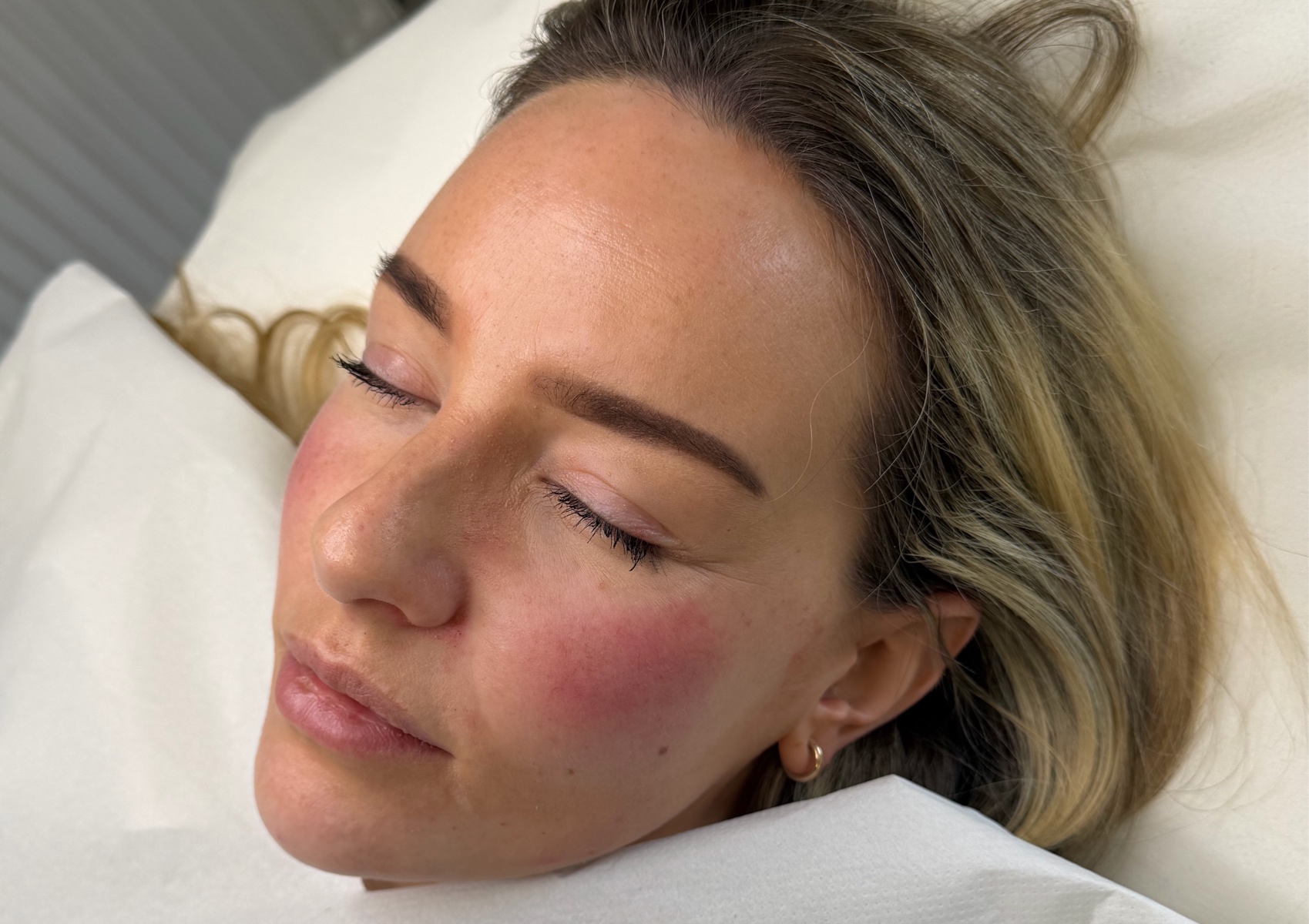 Full face rejuvenation (botox & filler)