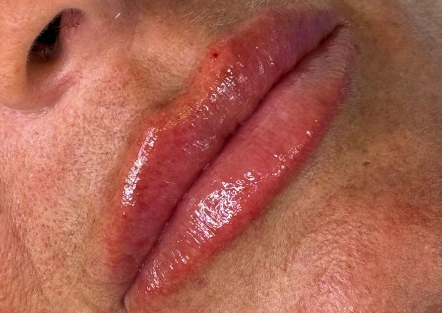 Lip Dissolve & Refill