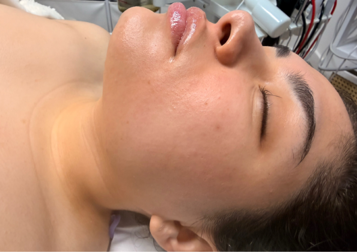 Lifting facial 