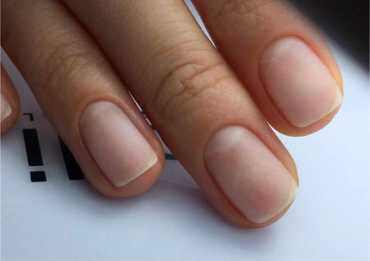 Gel removal