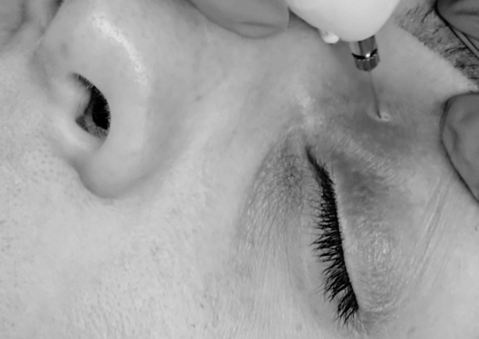 Remoción de Xantelasma con Fibroblast