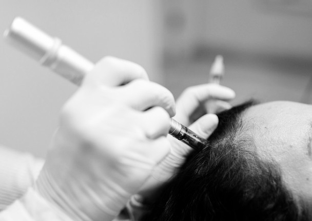 Tratamiento MesoCapilar