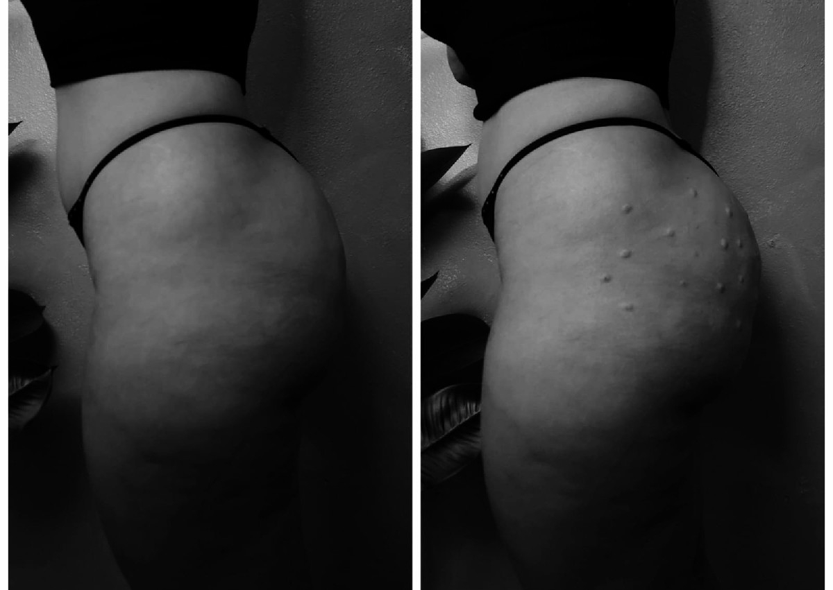 BBL + Plasma Rico en Plaquetas