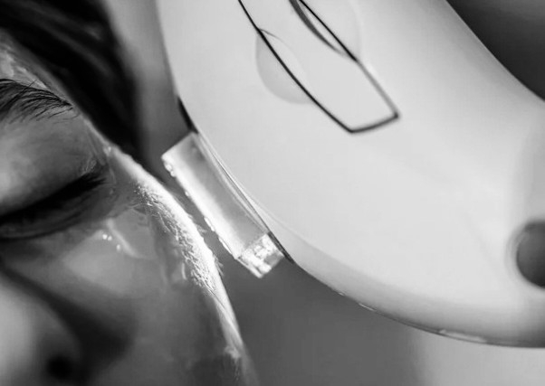 IPL Rosácea o Vascularidad