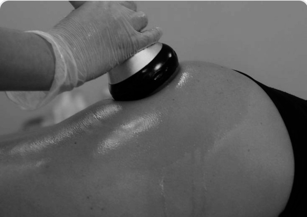 6 Sesiones Cuppings of Buttocks Muslos y Glúteos 