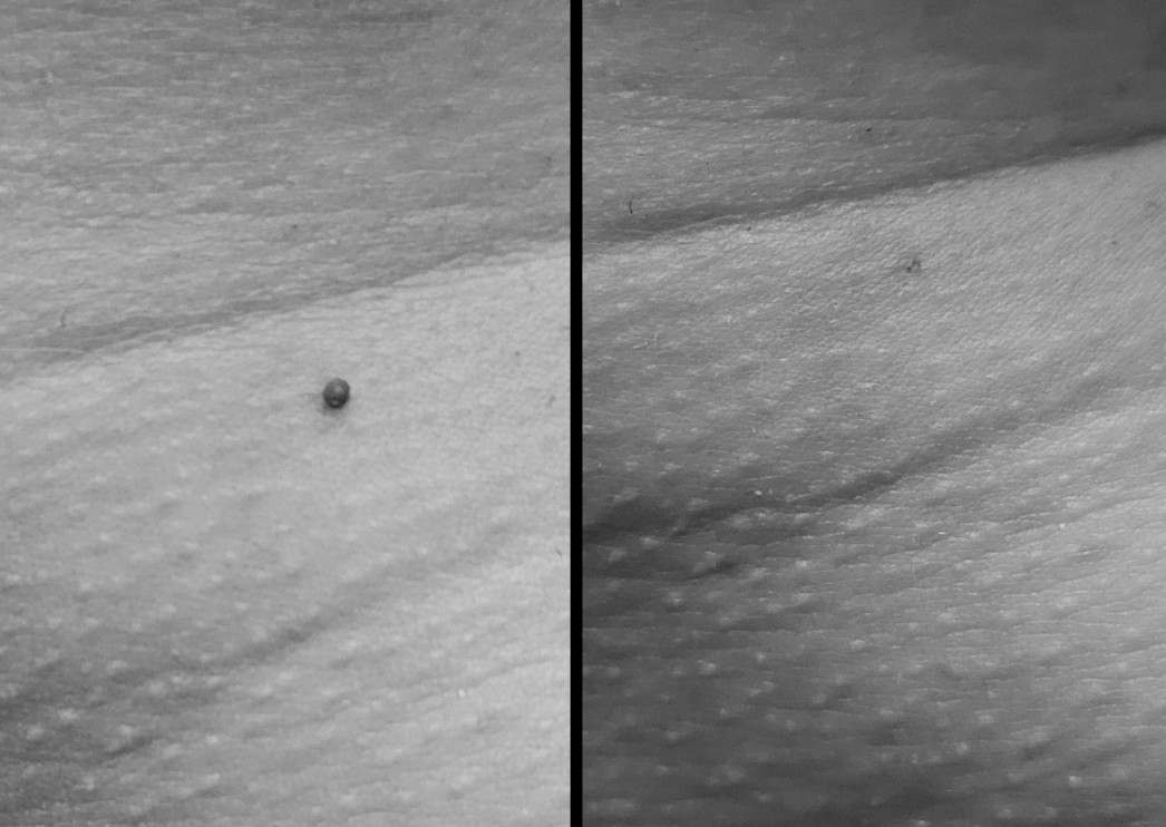 Remoción Berrugas con Fibroblast