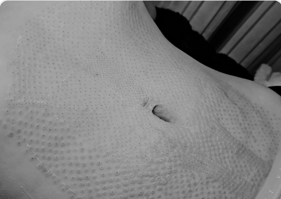 1 Sesion Fibroblast Full Abdomen Flacidez y Estrías 
