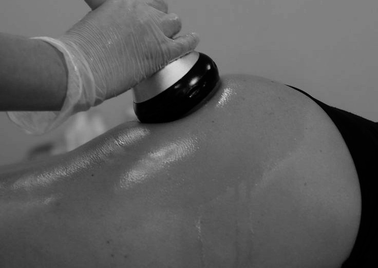 Cuppings of Buttocks 