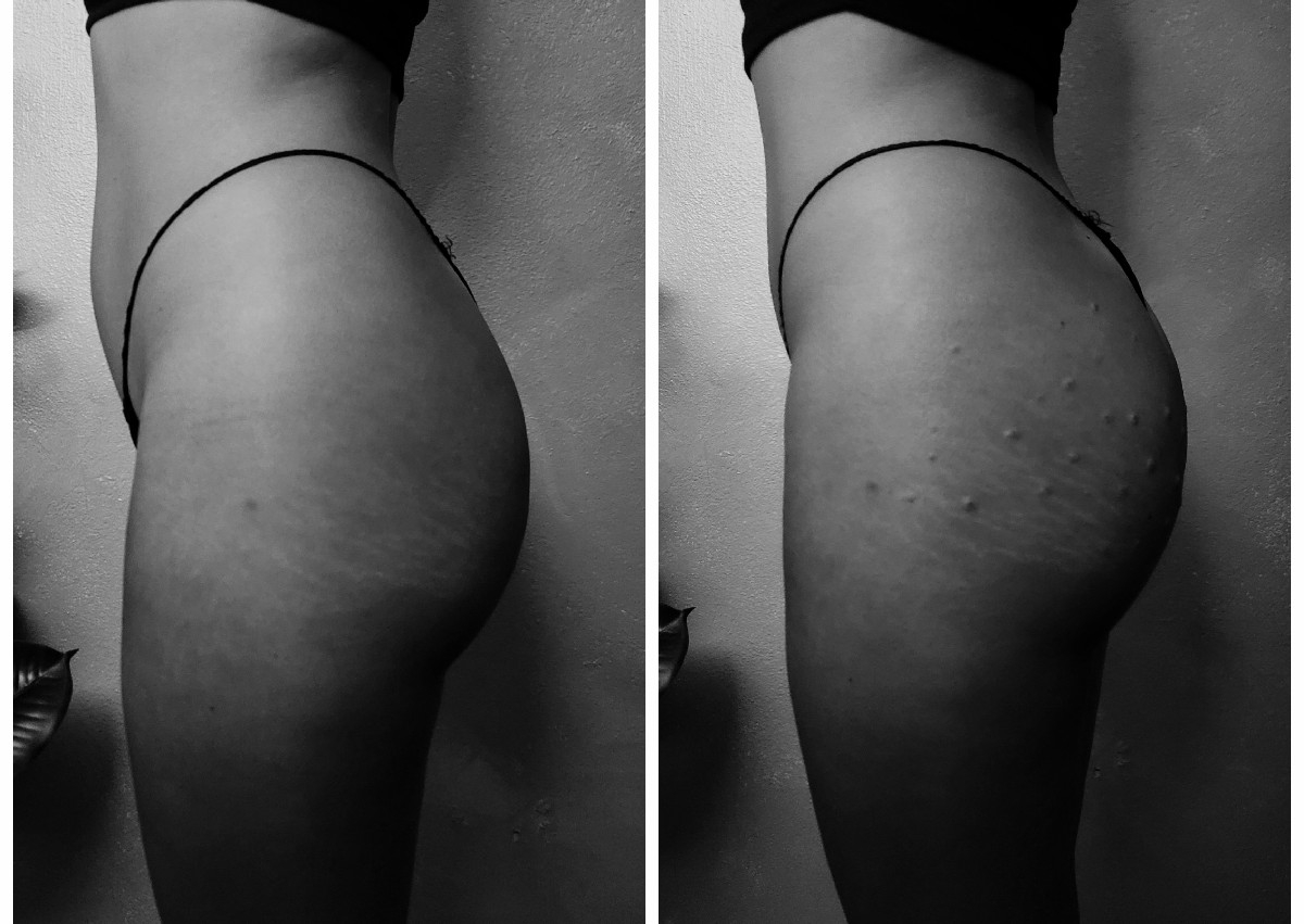 BBL + Plasma Gel Plasma Rico en Plaquetas Hip Dips