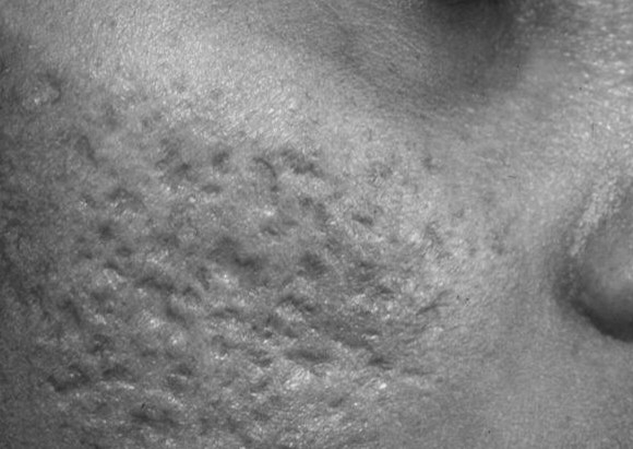 Fibroblast Cicatrices de acné 