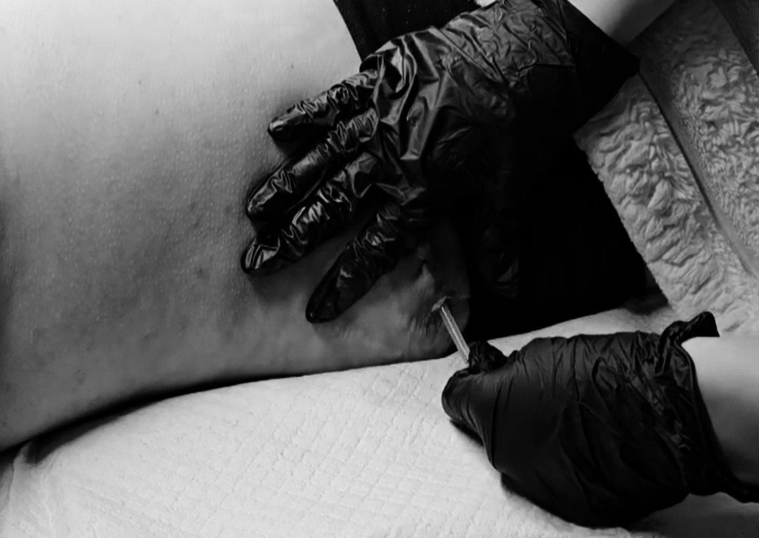 Remoción de Drenaje