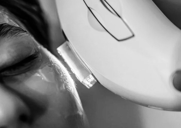 IPL Rejuvenecimiento Antiage