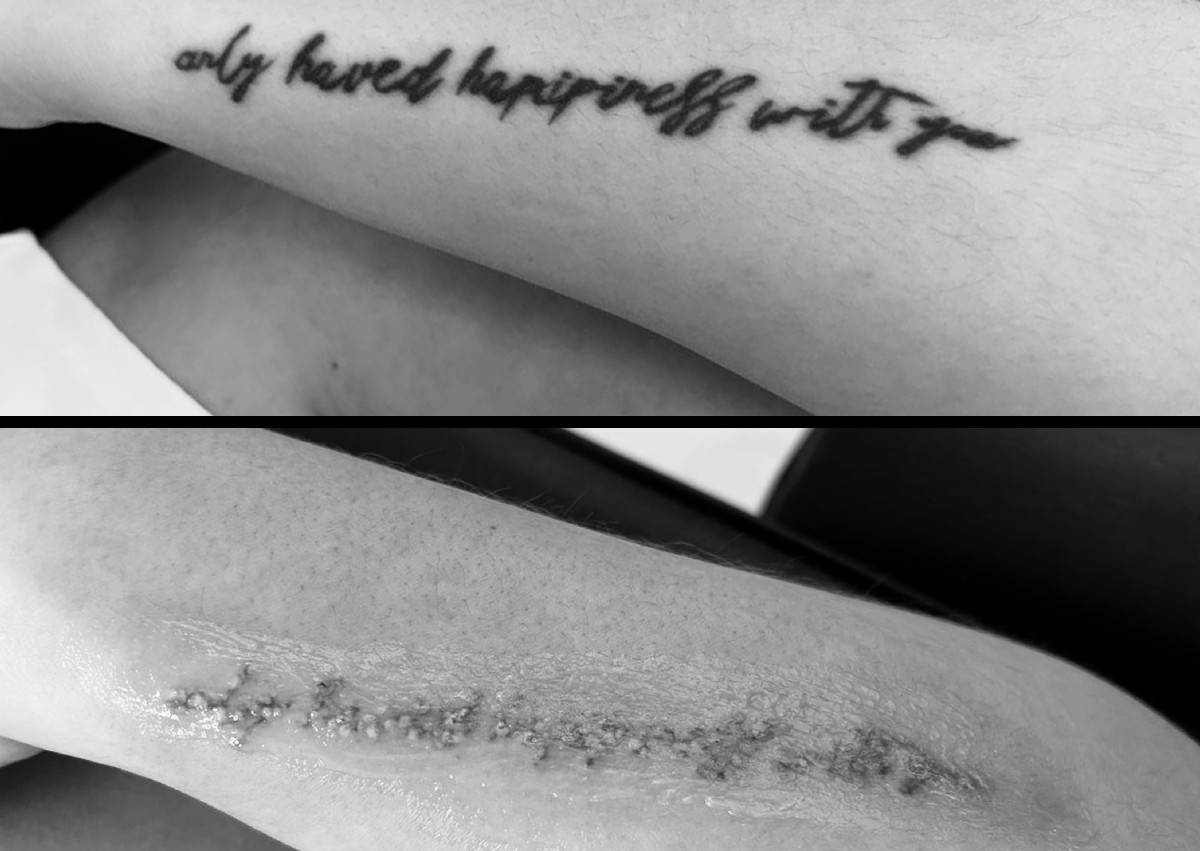 Remoción de Tatuaje 