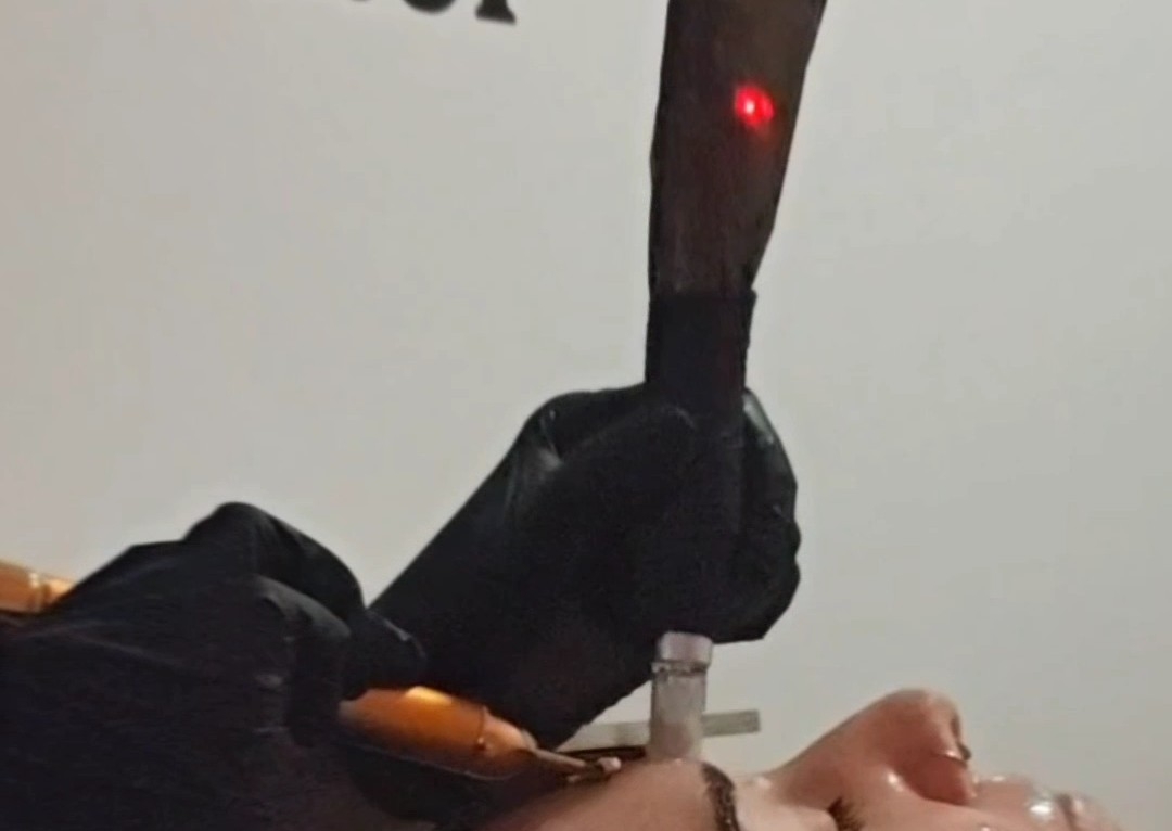 Microagulhamento premium c/exossomas * Premium microneedling w/exossomes