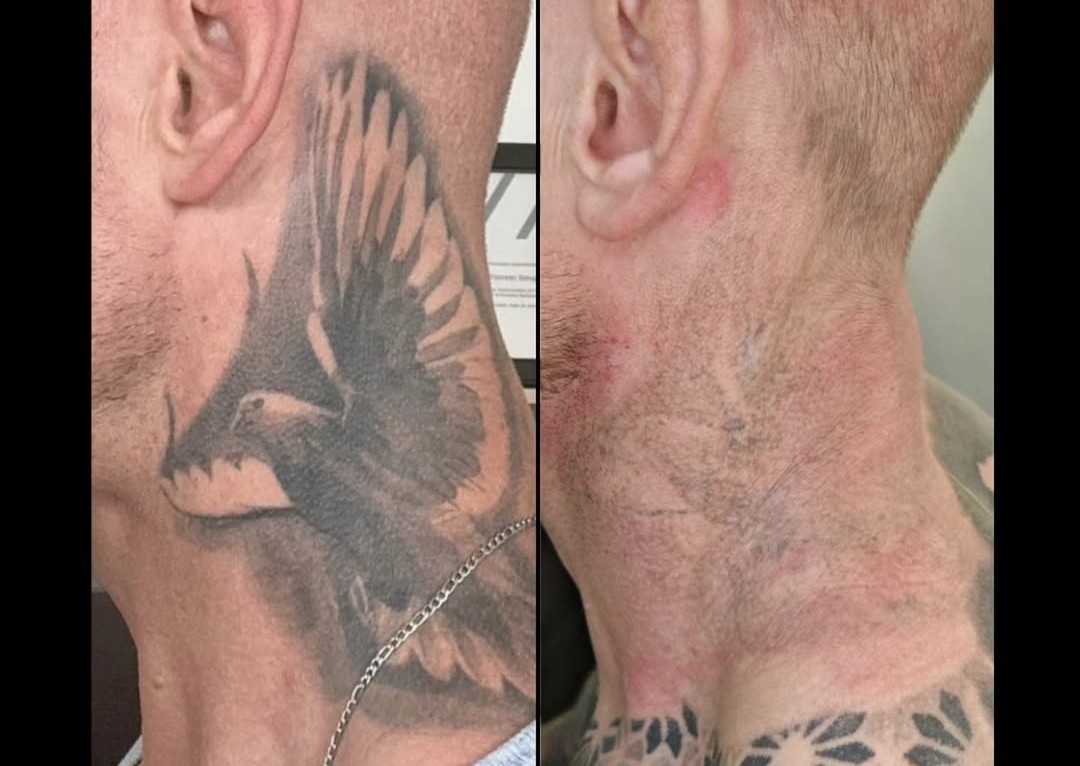 Remoção tatuagem/ Tatoo removal