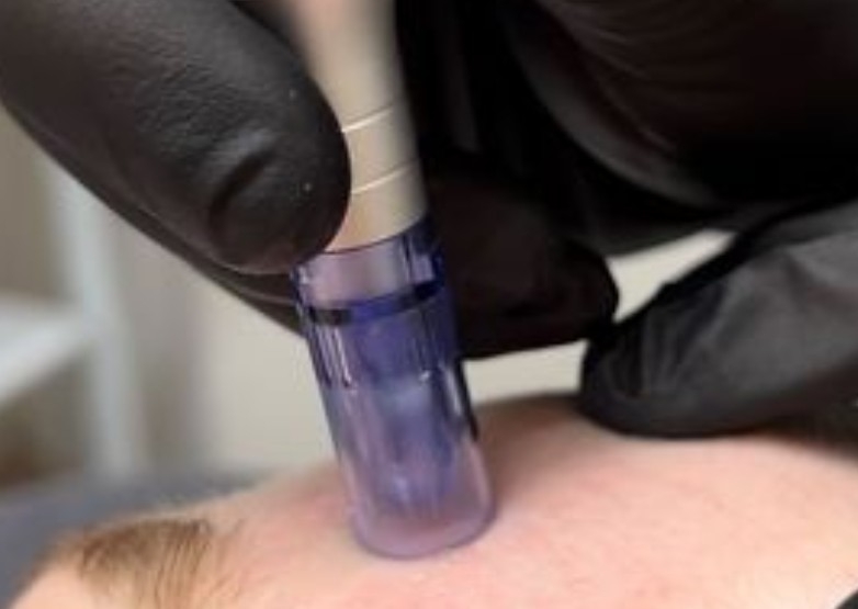 Skin reset+microneedling exossomes 