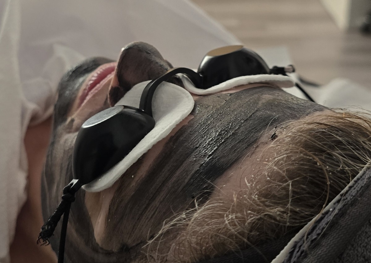 Carbon laser+microneedling  exossomes 