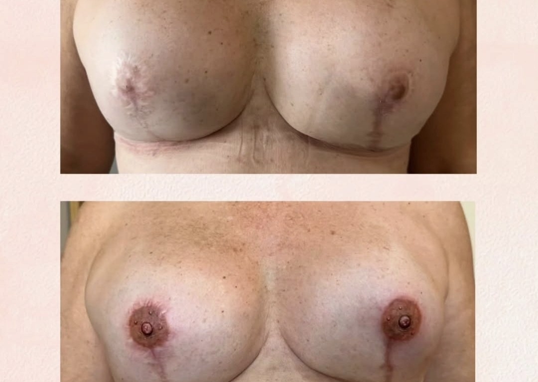 Micropigmentação paramédica • Paramedical micropigmentation