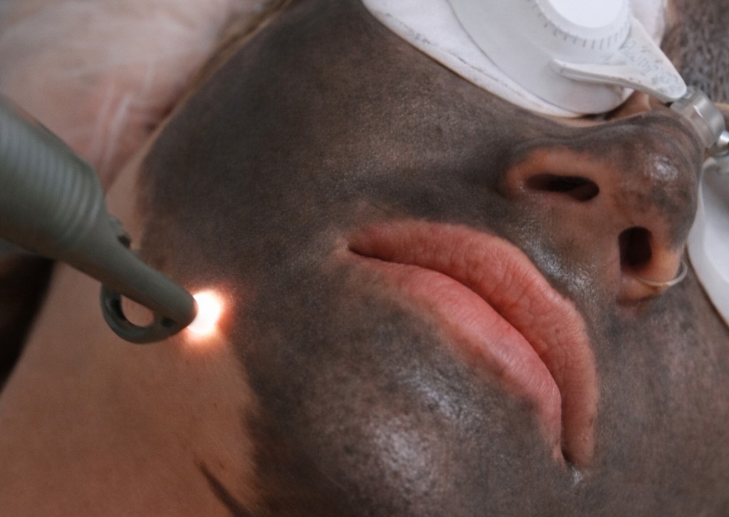 Carbon Laser + microneedling 
