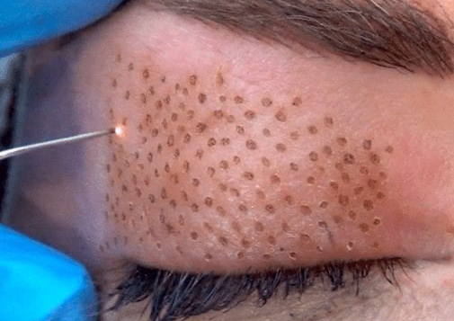 Fibroblast skin tightening 