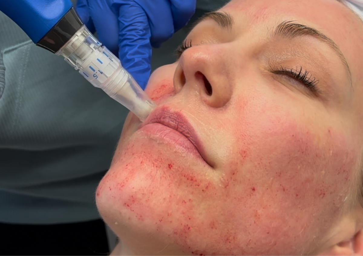 Microneedling 