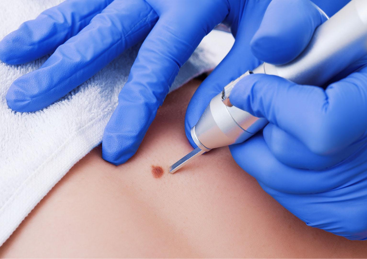 Remocion de verrugas 