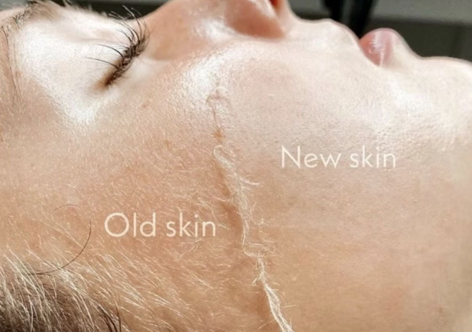 DERMAPLANE FACIAL
