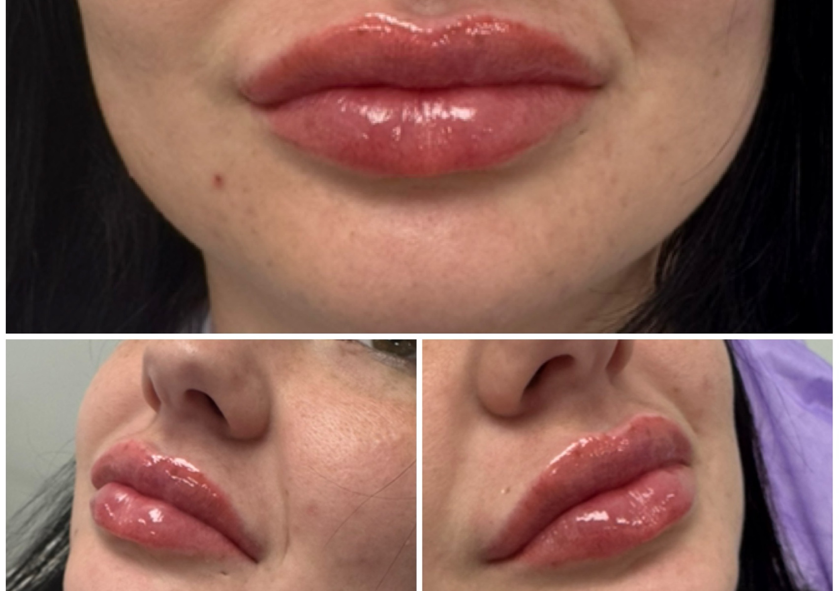 Lip Filler