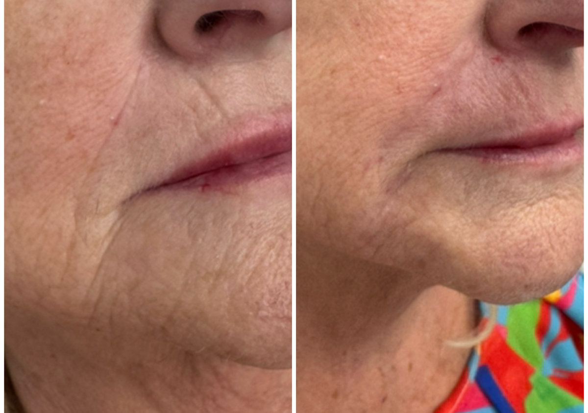 Face Filler