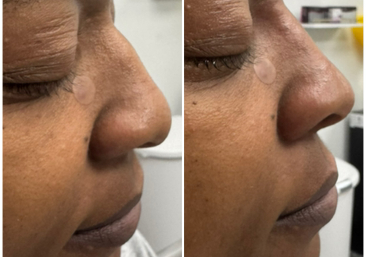 Liquid Rhinoplasty 
