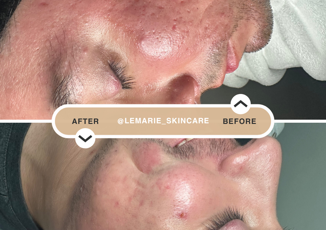 Lemarie Clear Skin Facial Anti-Acné ✨