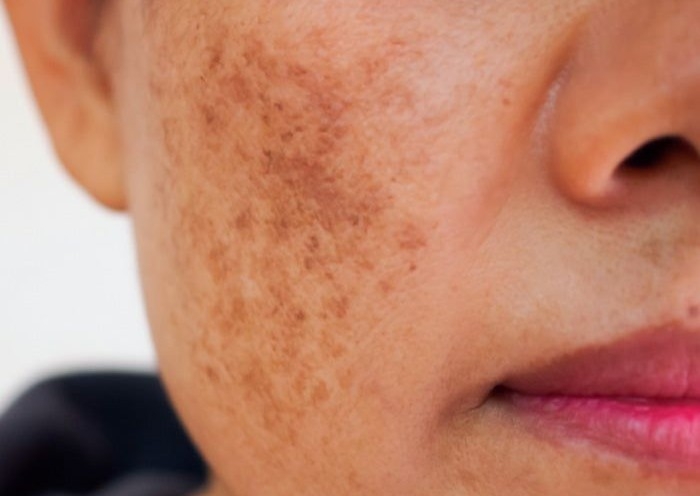 Facial despimentante