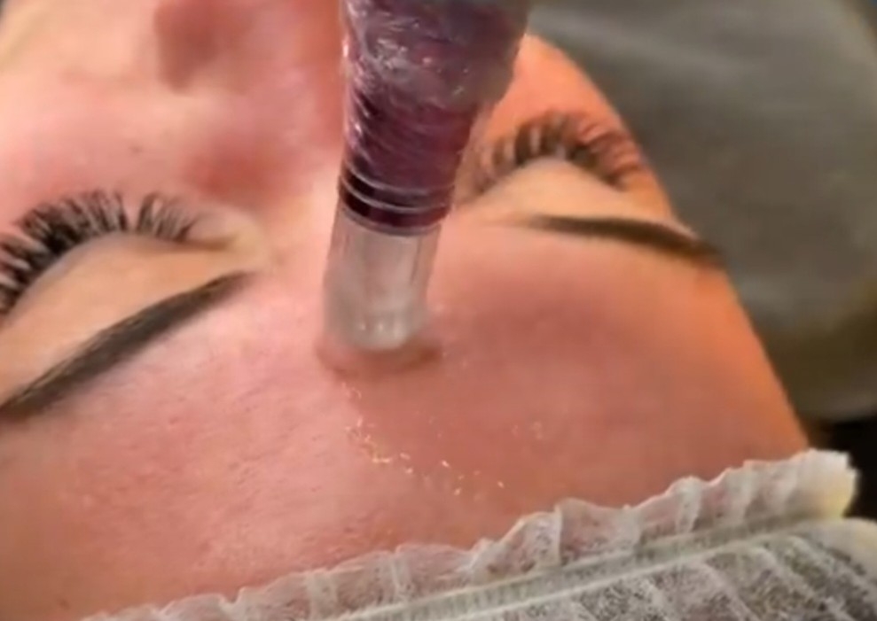 Facial microneedling