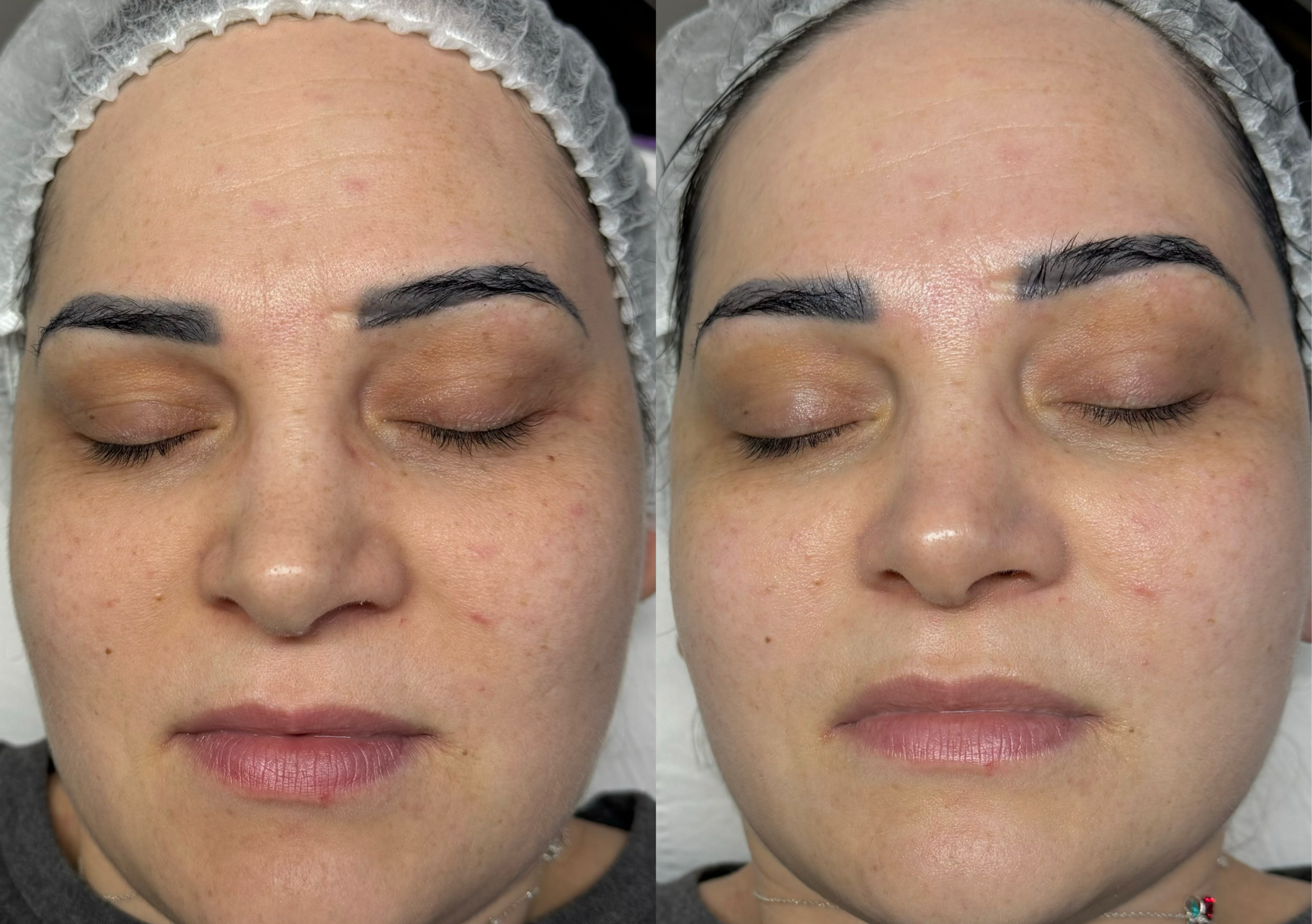 Resurfacing Medipeel (glycolic acid 20% & 40%)