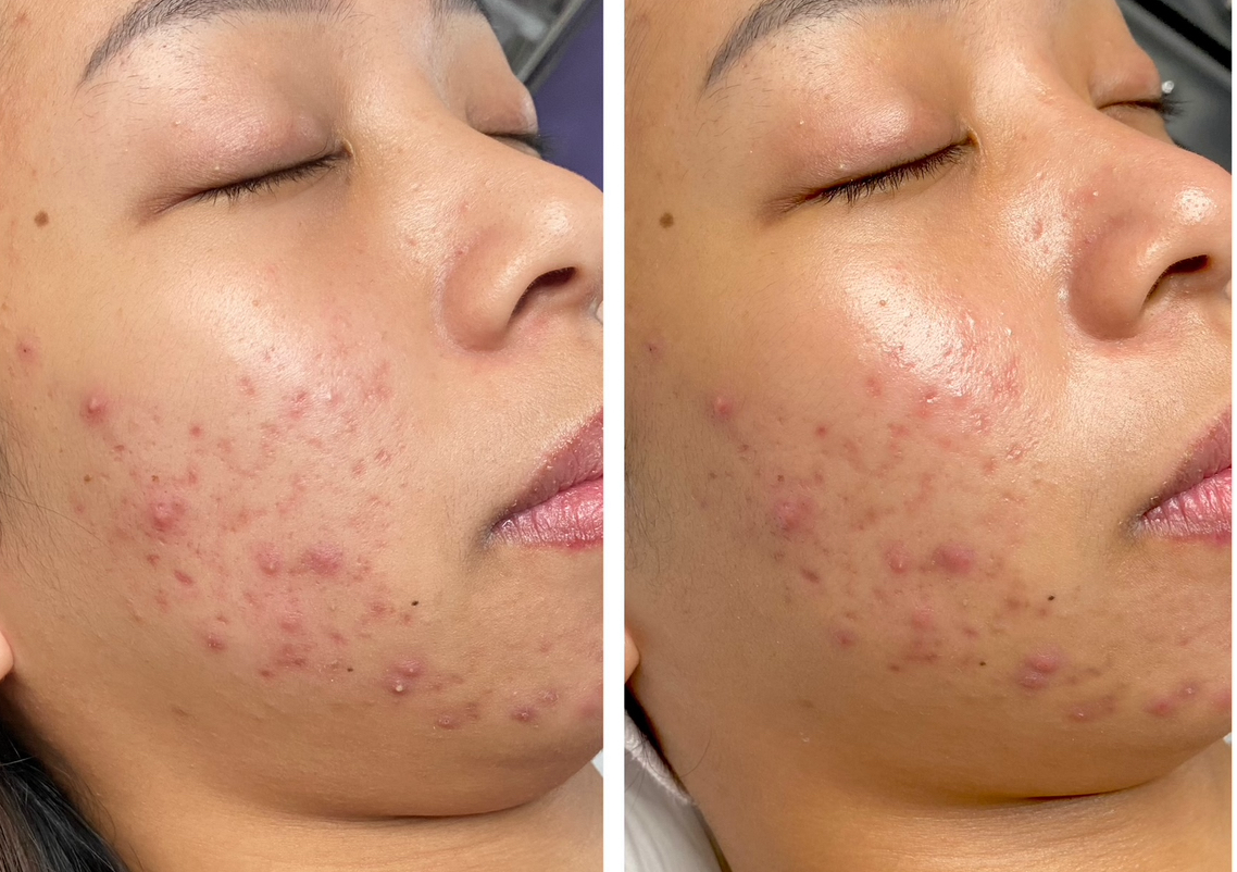 High Frequency & LED blue light Acne treatment