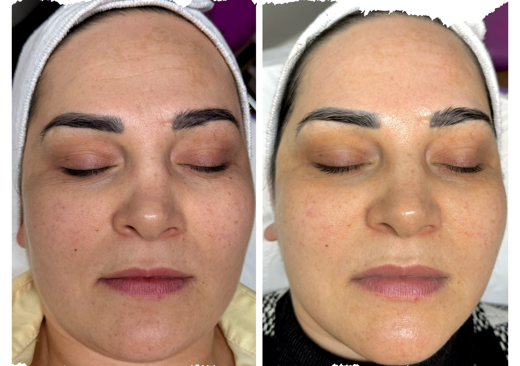 Rejuvenating PeptiElixir Mesotherapy
