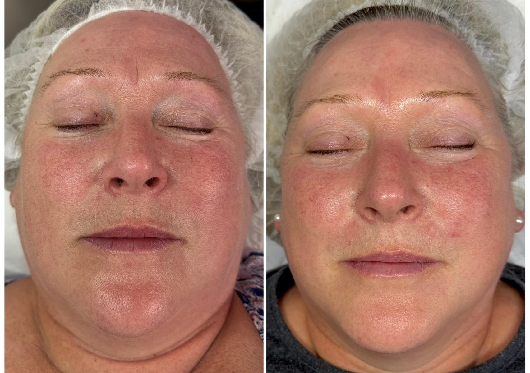 CrystalFrax rejuvenation